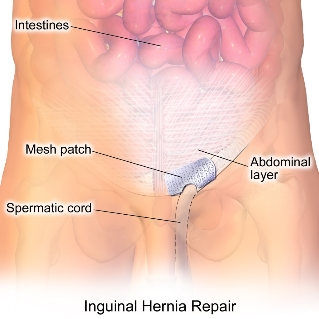 Mccallister Law Group Provides Legal Advise Regarding Hernia Mesh