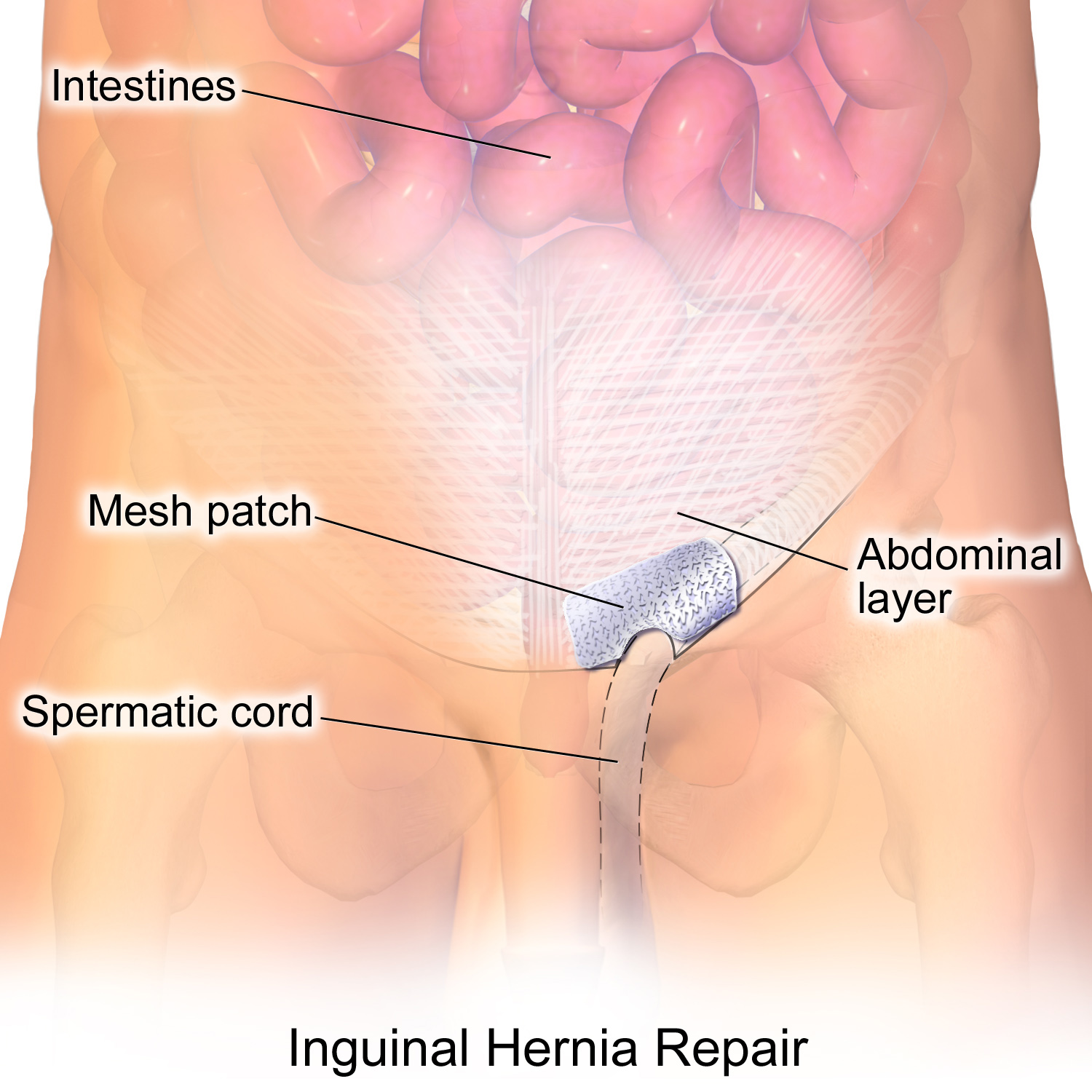 McCallister Law Group Provides Legal Advise Regarding Hernia Mesh McCallister Law Group Provides Legal Advise Regarding Hernia Mesh